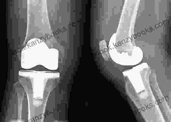 Total Knee Replacement Surgery Total Knee Replacement: 12 Weeks To Success